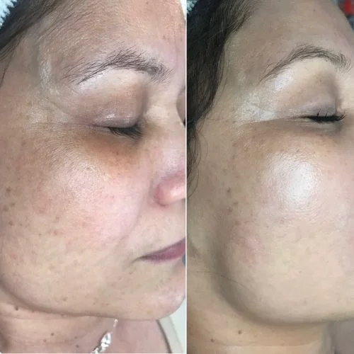 microagulhamento em cascais na Lourdes Estetica