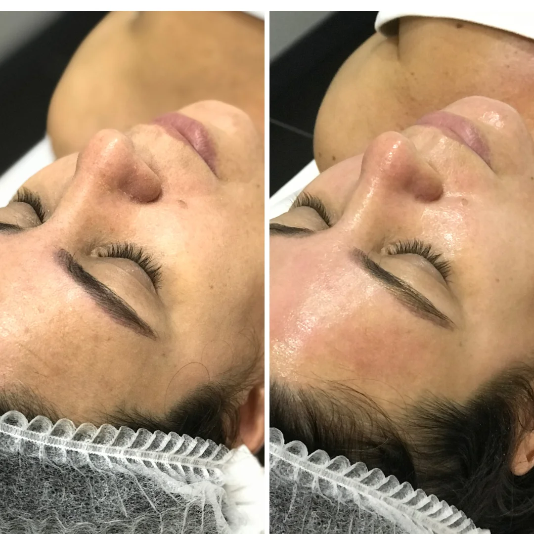 microagulhamento em cascais na Lourdes Estetica