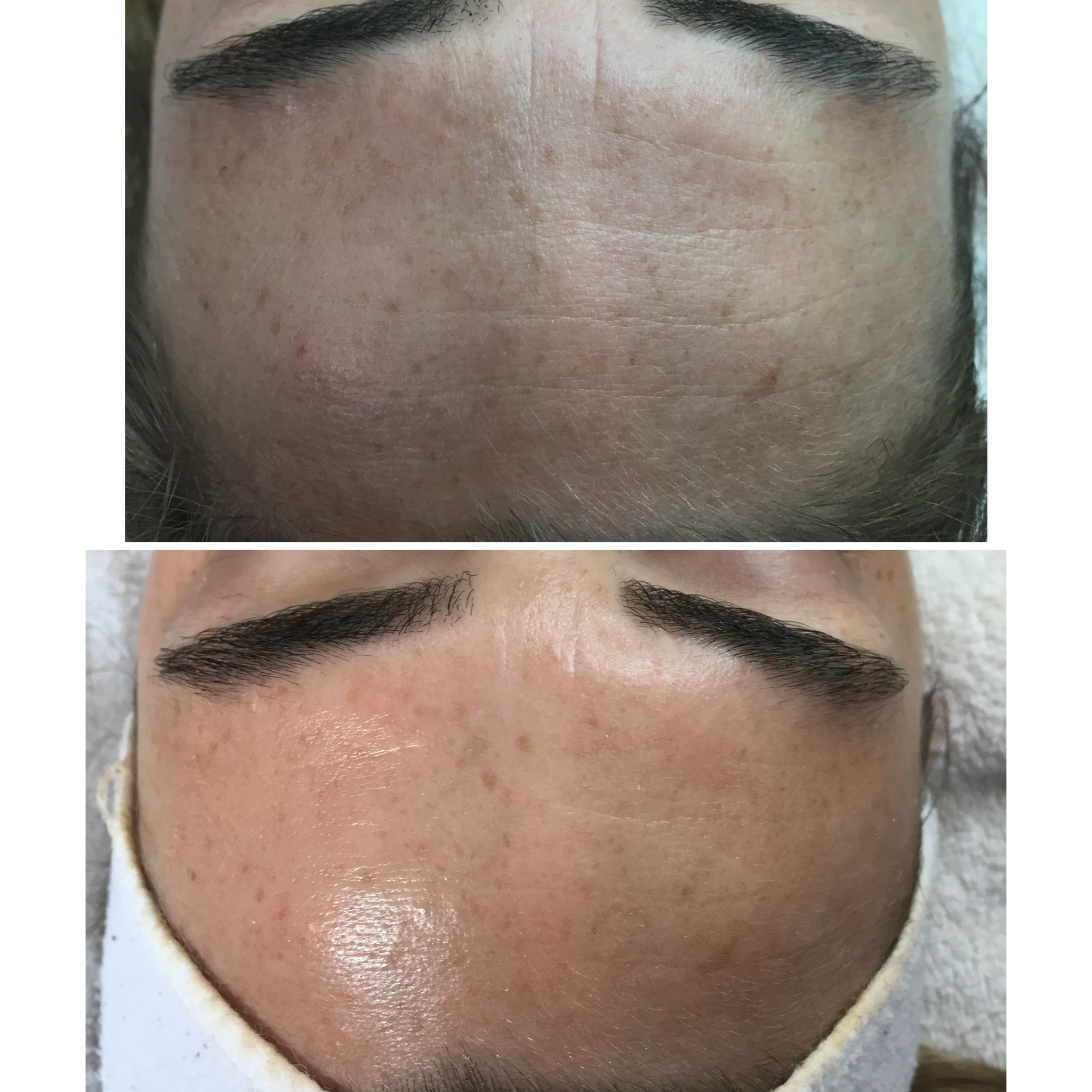 TRATAMENTO ANTIEVELHECIMENTO