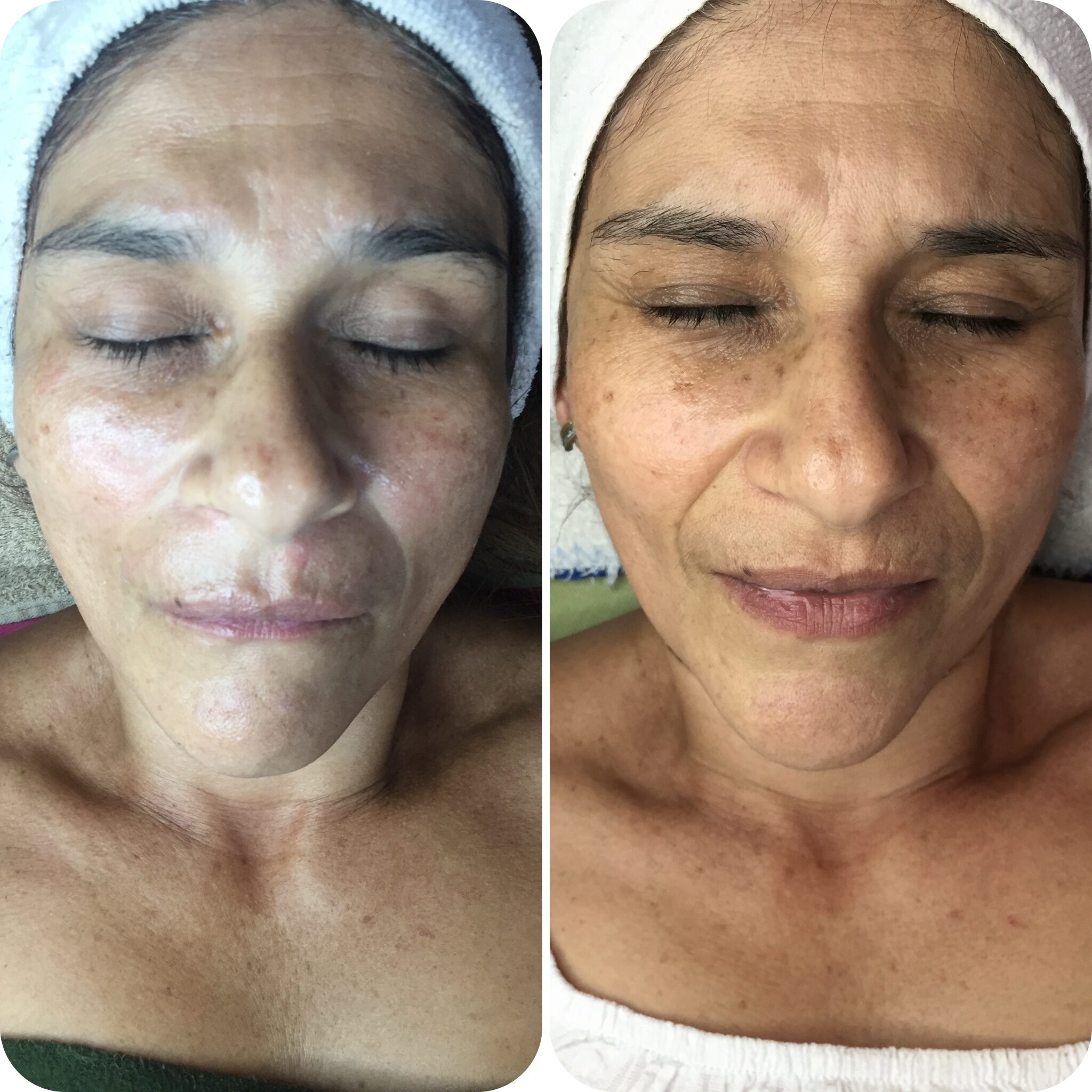 microagulhamento em cascais na Lourdes Estetica