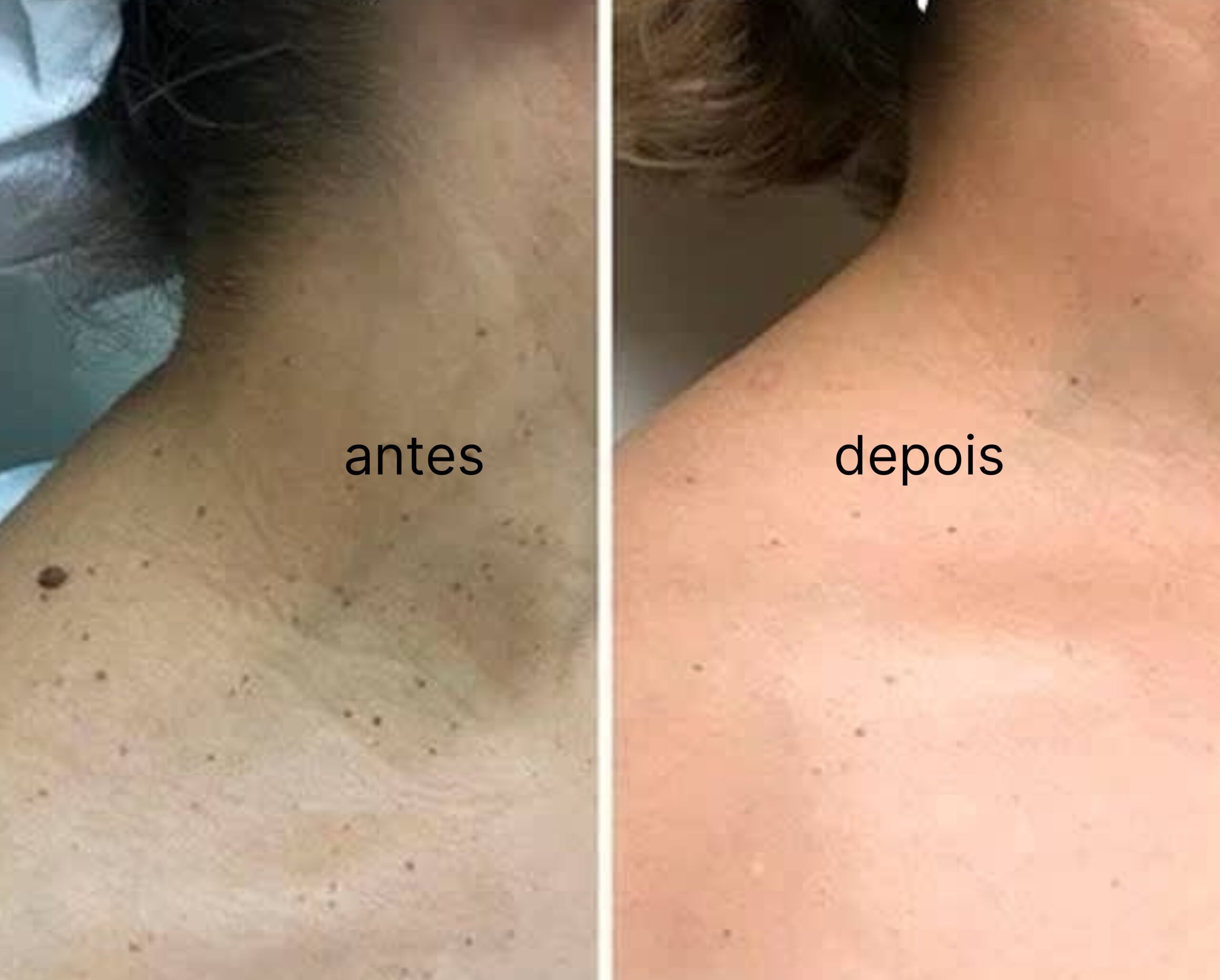 Jato de plasma - Lourdes Estetica em Cascais