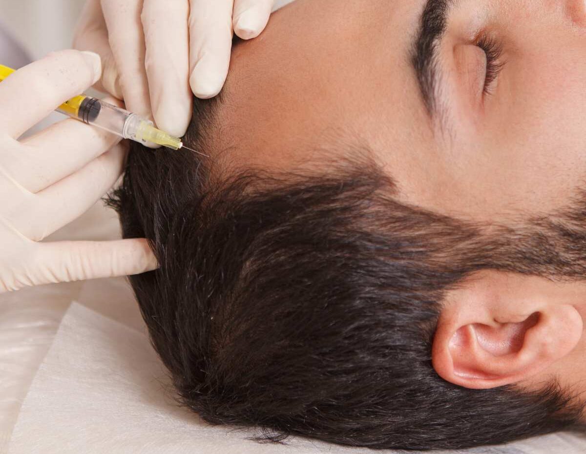 Tratamento para alopecia na Lourdes Estética em Cascais.