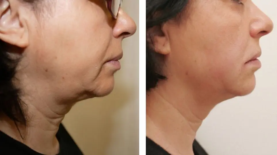 hifu facial cliente cascais