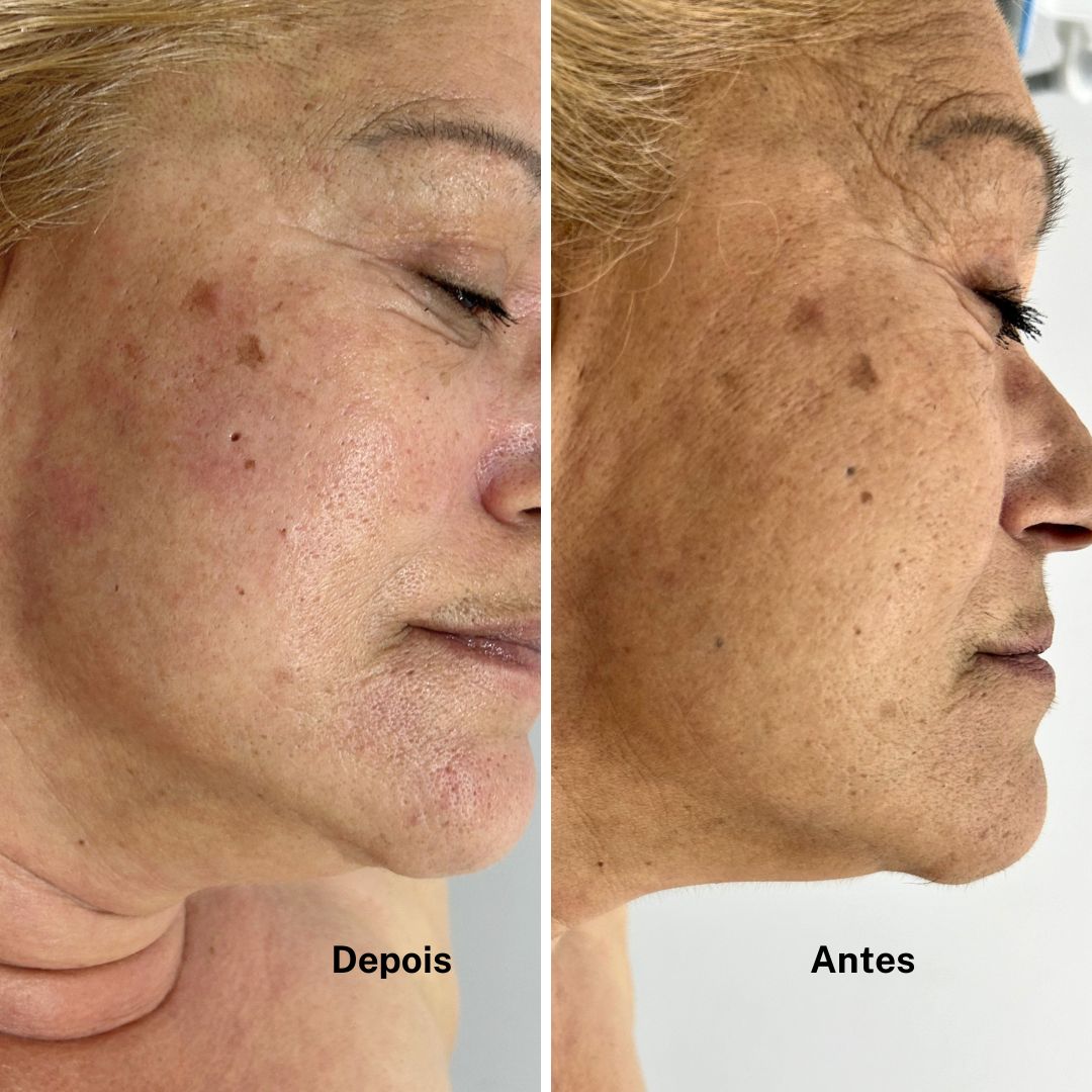 TRATAMENTO ANTIEVELHECIMENTO