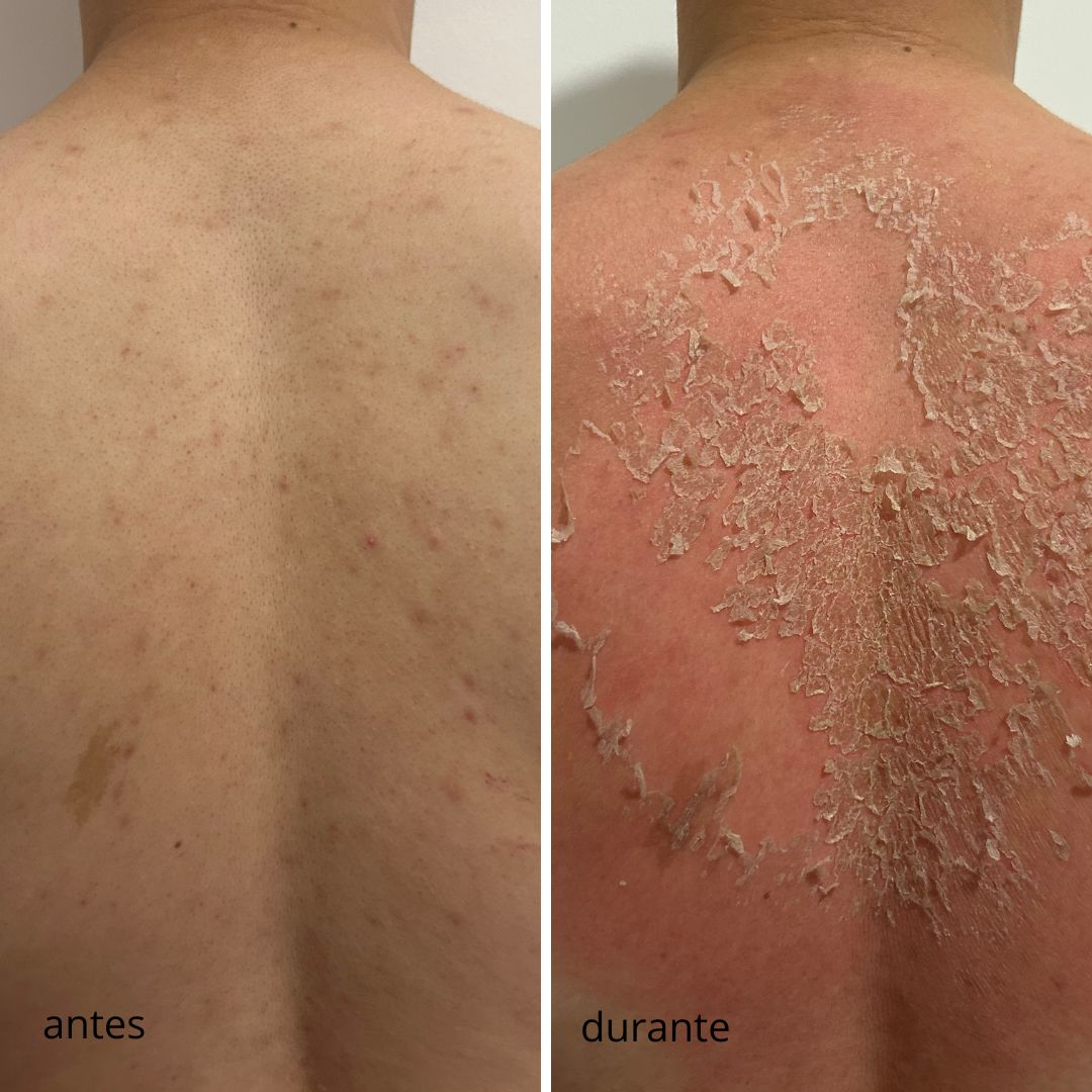 peeling de algas em cascais na Lourdes Estetica