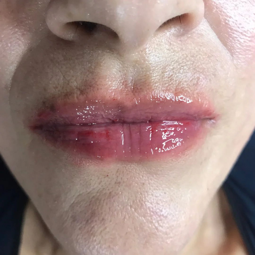 Antes e depois do BB Lips hidratação labial em Cascais - Lourdes Estética