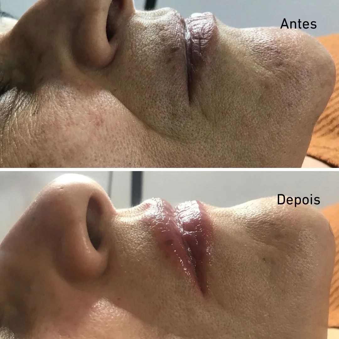 Lábios depois de sessão de Hidratação Labial, Lourdes Estética Cascais