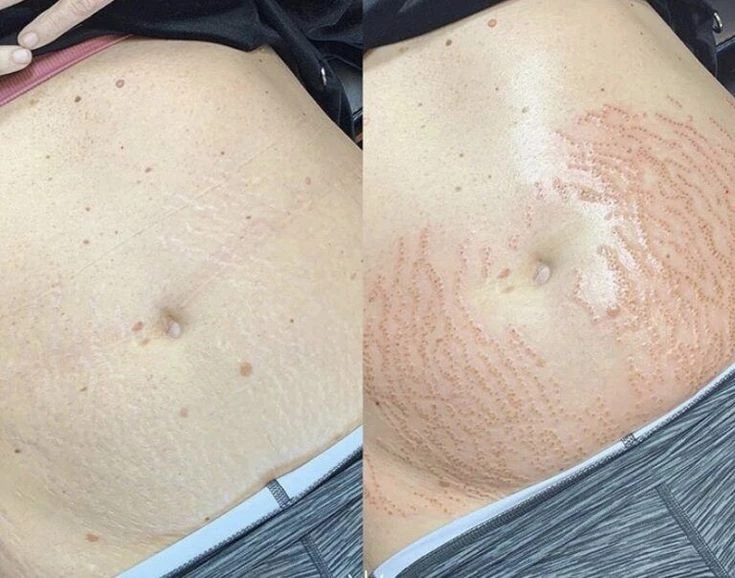 JatodePlasma-LourdesesteticaCascais3