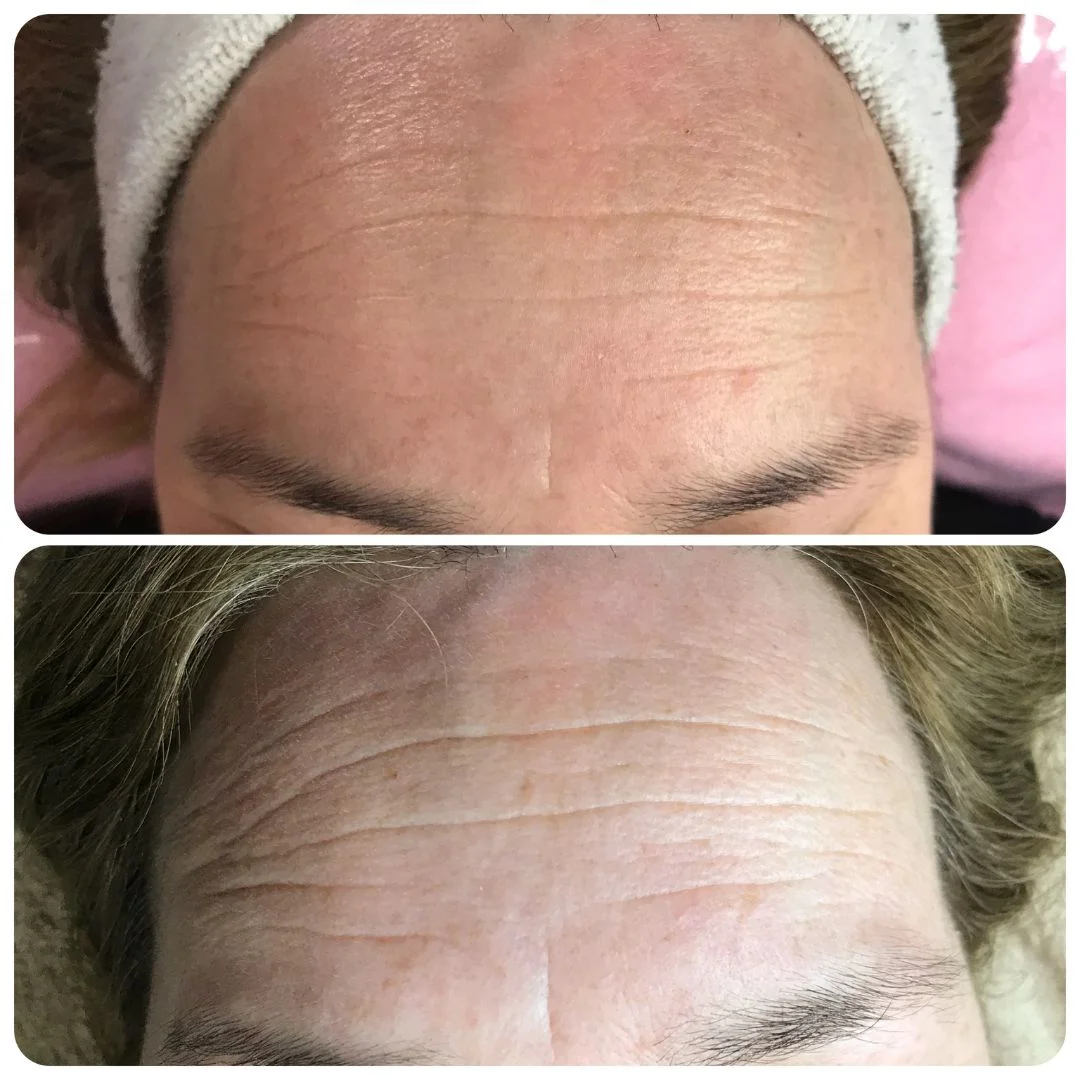 Resultado microagulhamento antes e depois em Cascais - Lourdes Estética