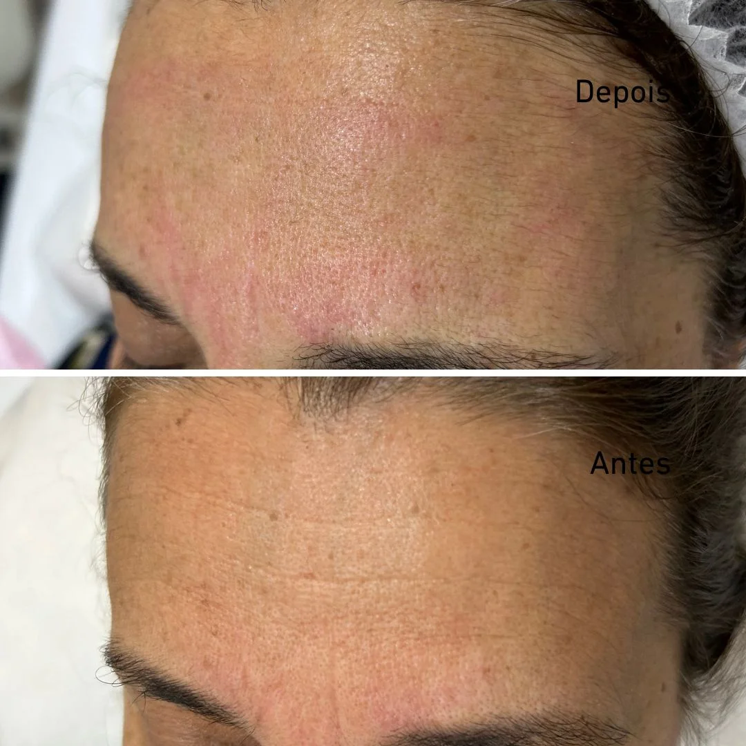 Resultado microagulhamento antes e depois em Cascais - Lourdes Estética