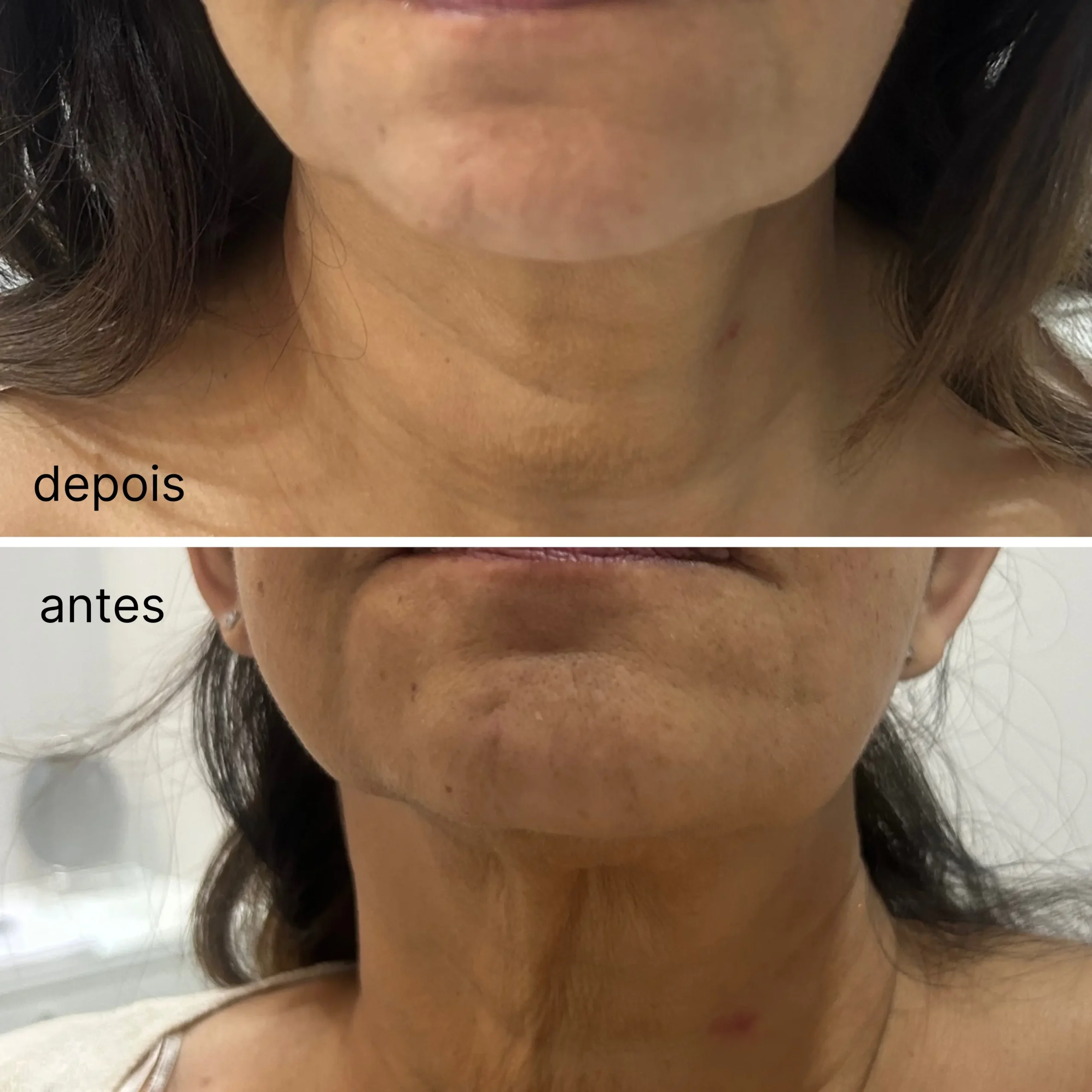 Resultado HIFU Frozen facial em Cascais — pele mais firme