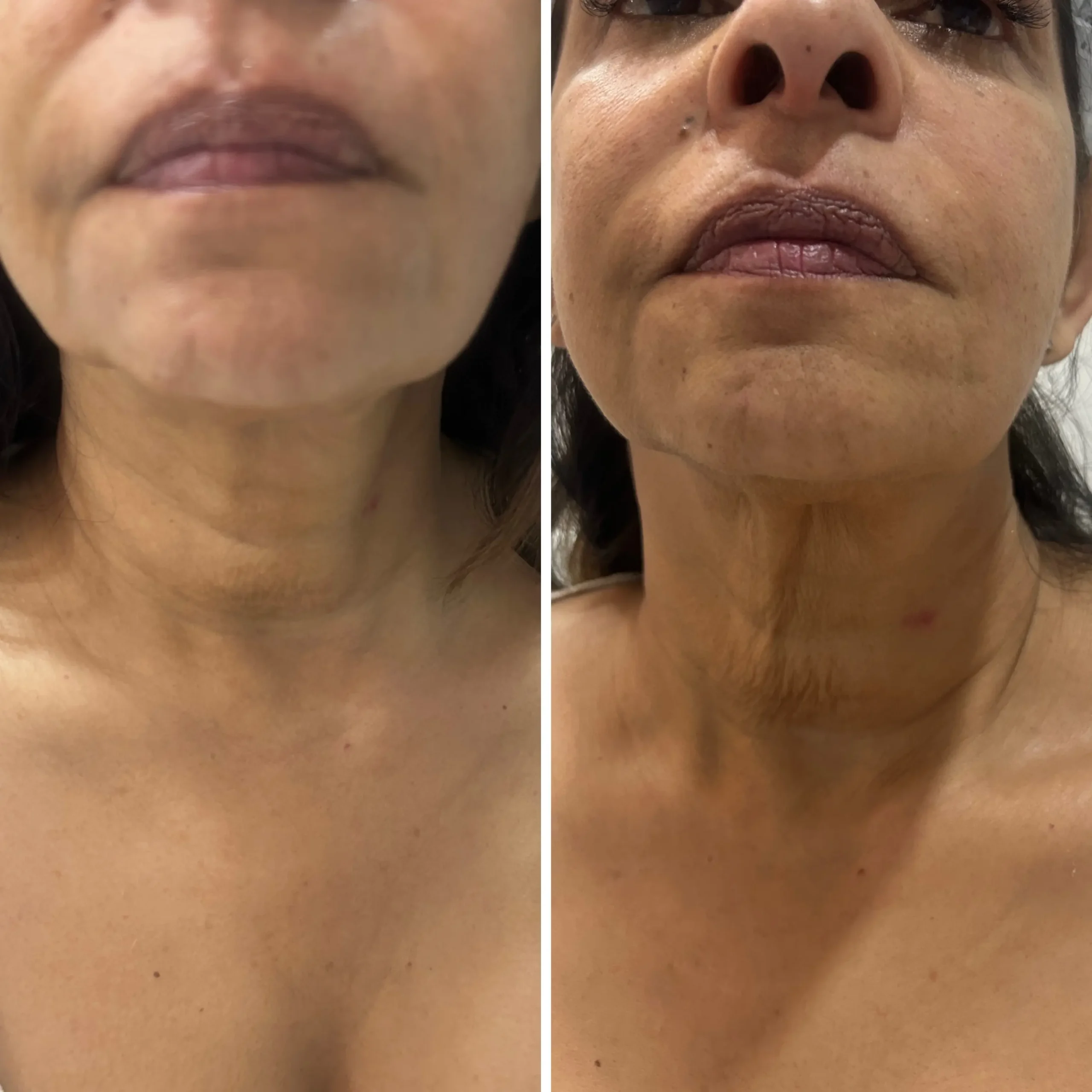 Antes e depois HIFU Frozen facial em Cascais — contorno reafirmado