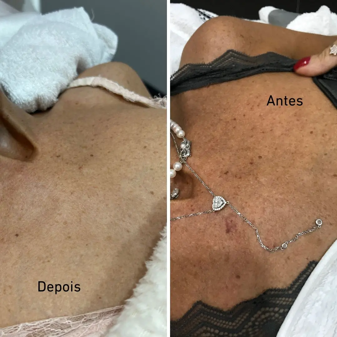 Peeling de algas antes e depois: manchas solares nas mãos