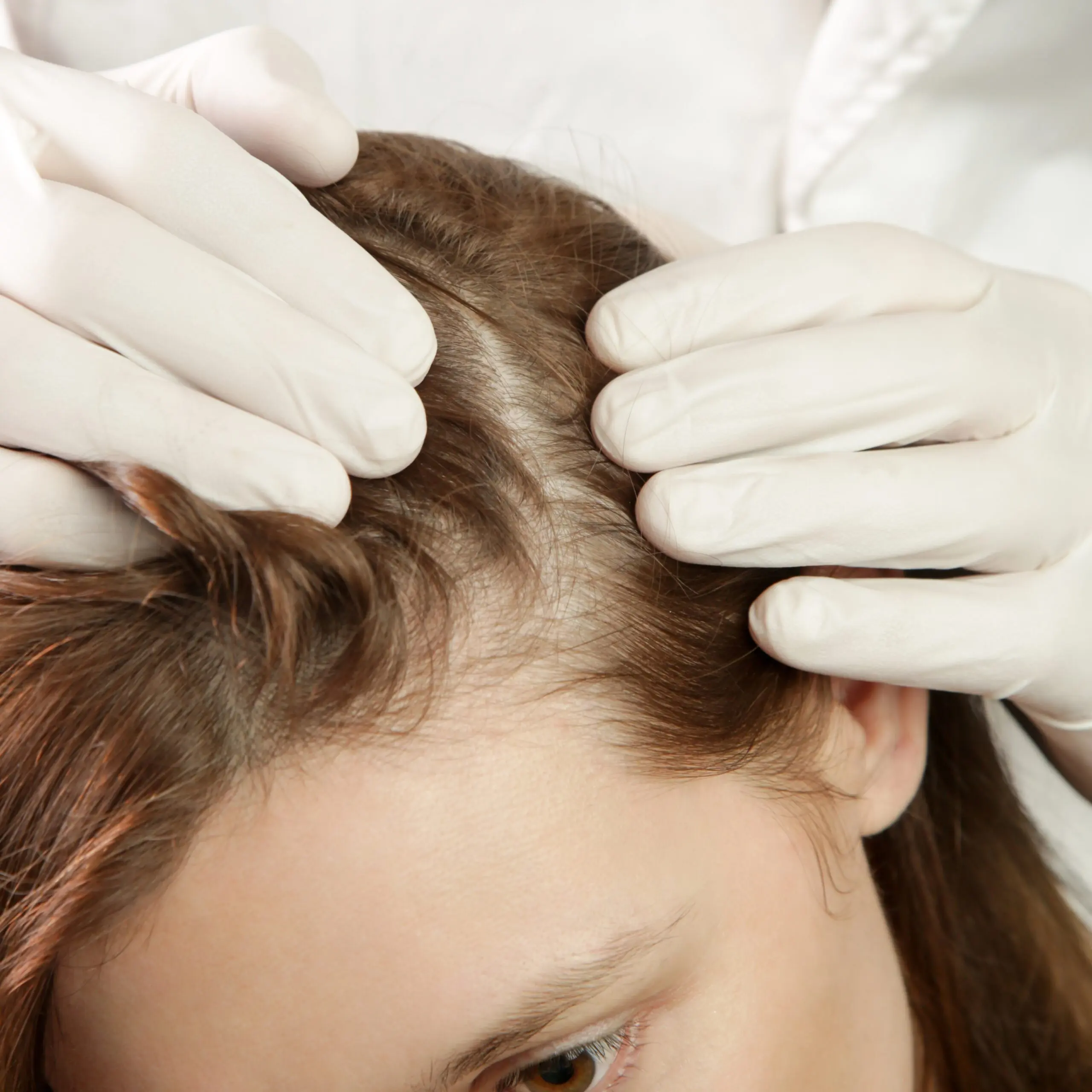 Tratamento para alopecia em Cascais - Lourdes Estetica