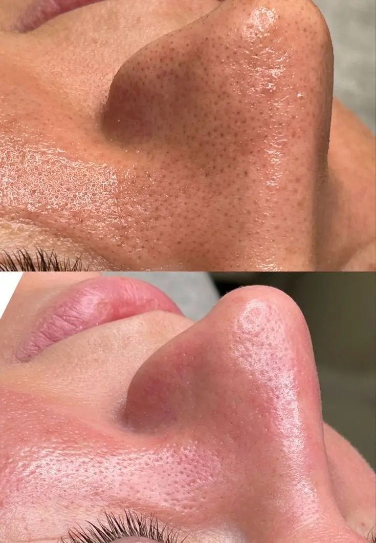 Resultado Limpeza Facial antes e depois em Cascais - Lourdes Estética