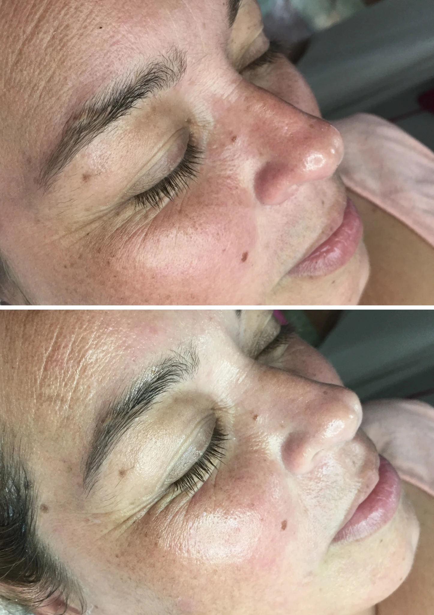 Resultado Limpeza Facial antes e depois em Cascais - Lourdes Estética