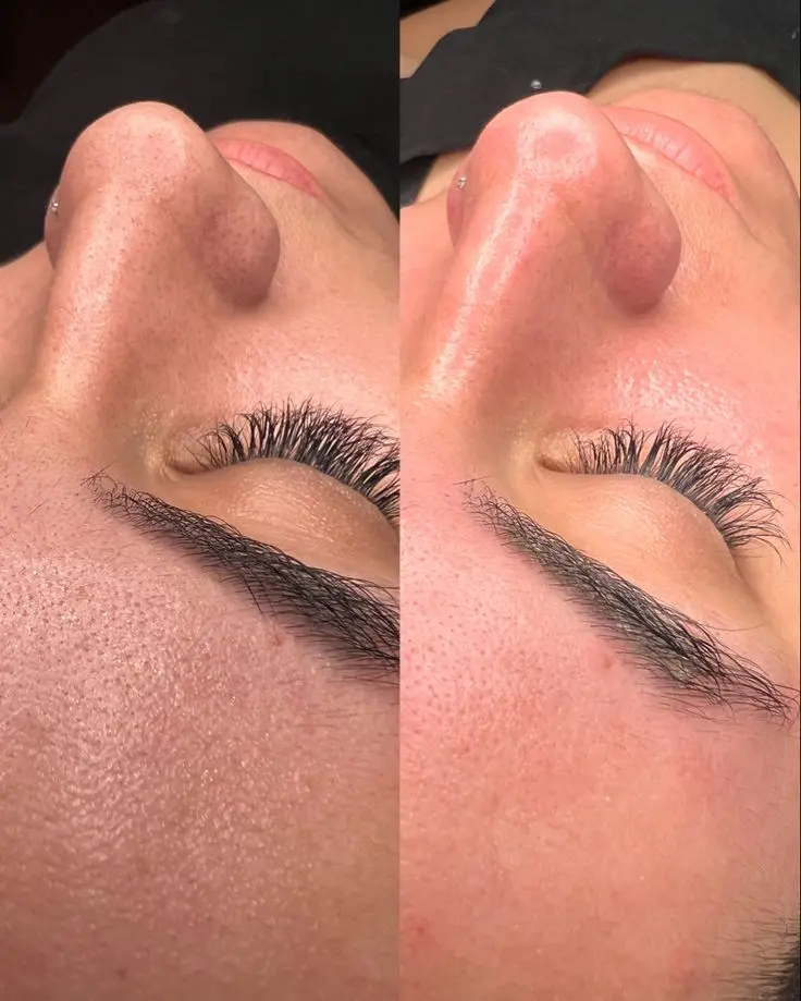 Resultado Limpeza Facial antes e depois em Cascais - Lourdes Estética