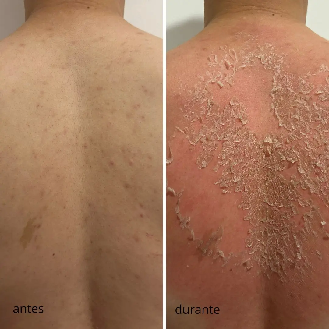 Peeling de algas antes e depois: acne ativa no rosto, 3 sessões