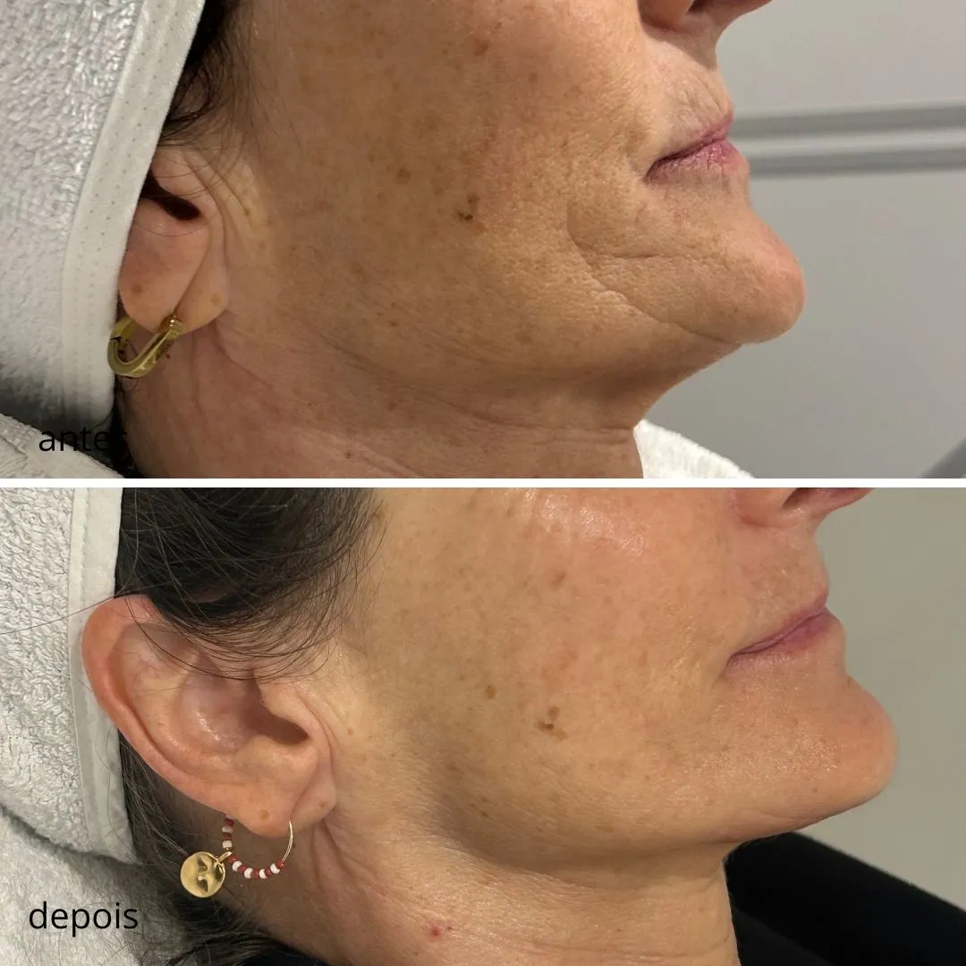 Peeling de algas antes e depois: textura irregular, 2 sessões