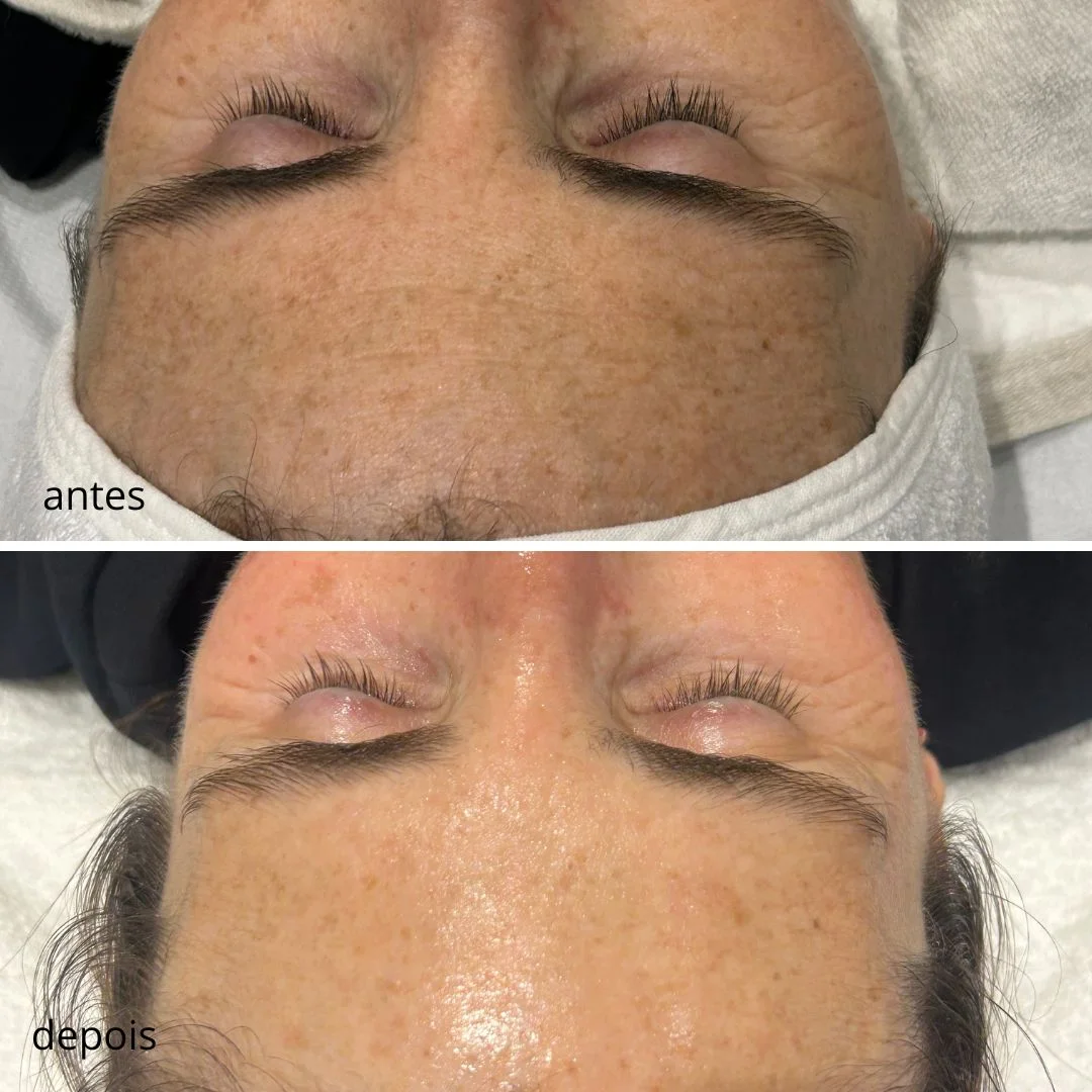 Peeling de algas antes e depois: manchas faciais, 2 sessões