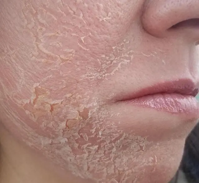 Tipos de exfoliação facial e corporal, e os ativos a identificar no INCI de cada produto