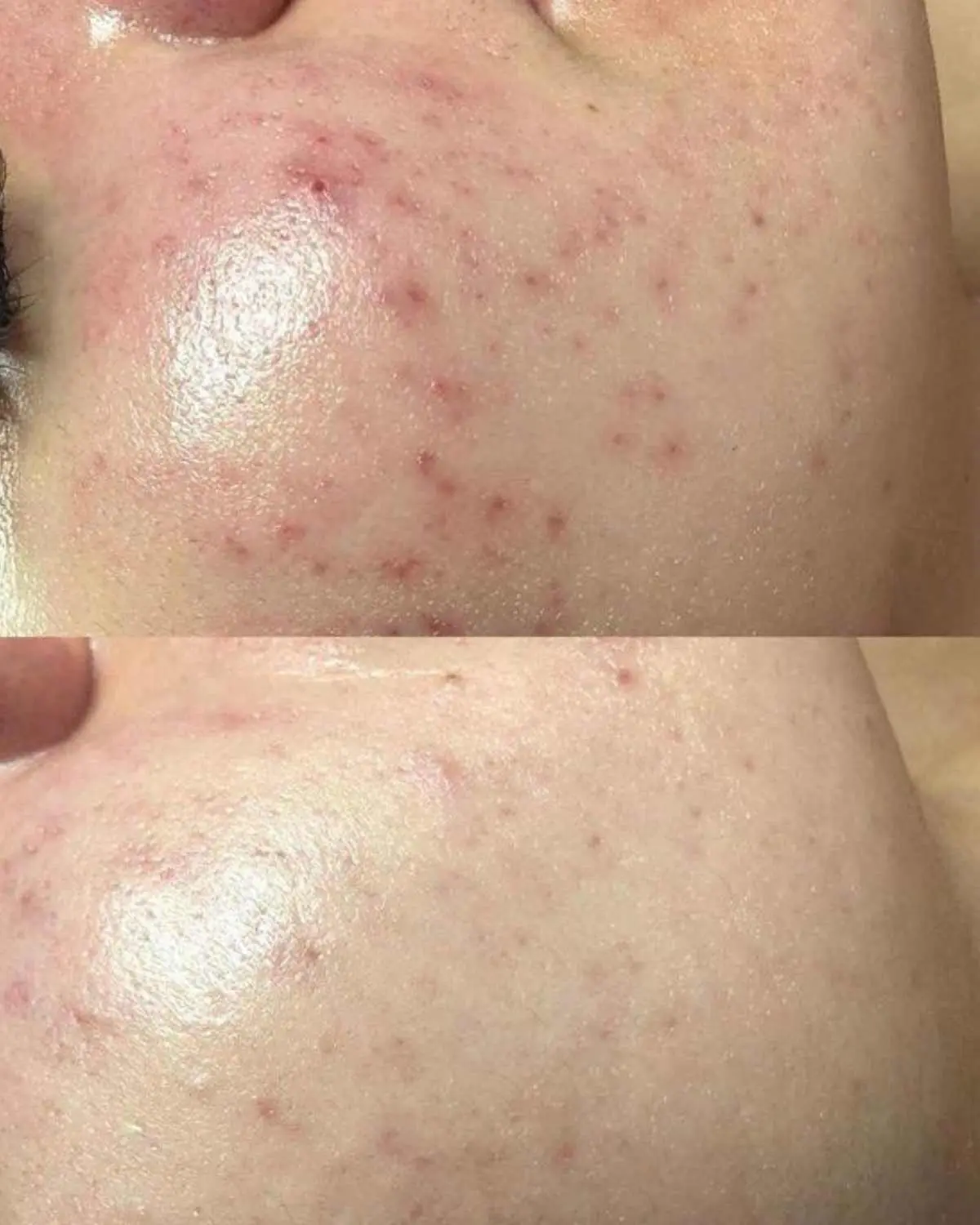 Peeling de algas antes e depois: melasma, protocolo combinado