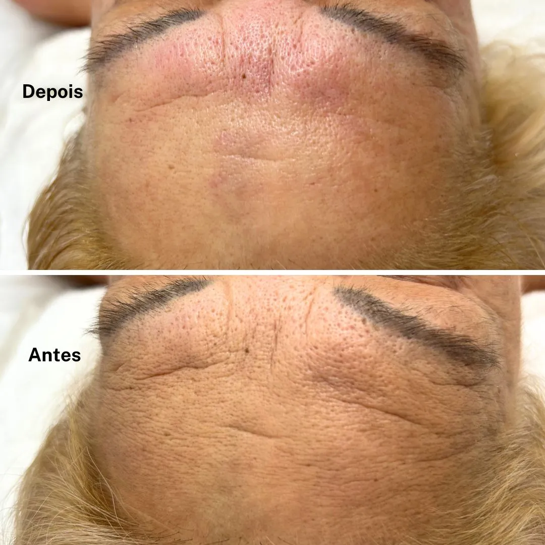 Resultado Tratamento Antienvelhecimento antes e depois em Cascais - Lourdes Estética