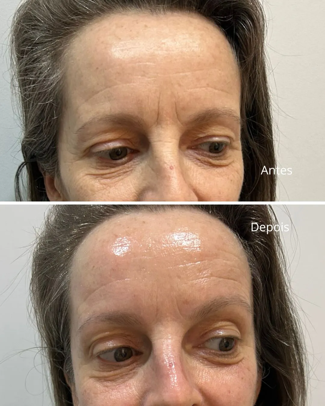 Tratamento Antienvelhecimento resultado cliente em Cascais - Lourdes Estética