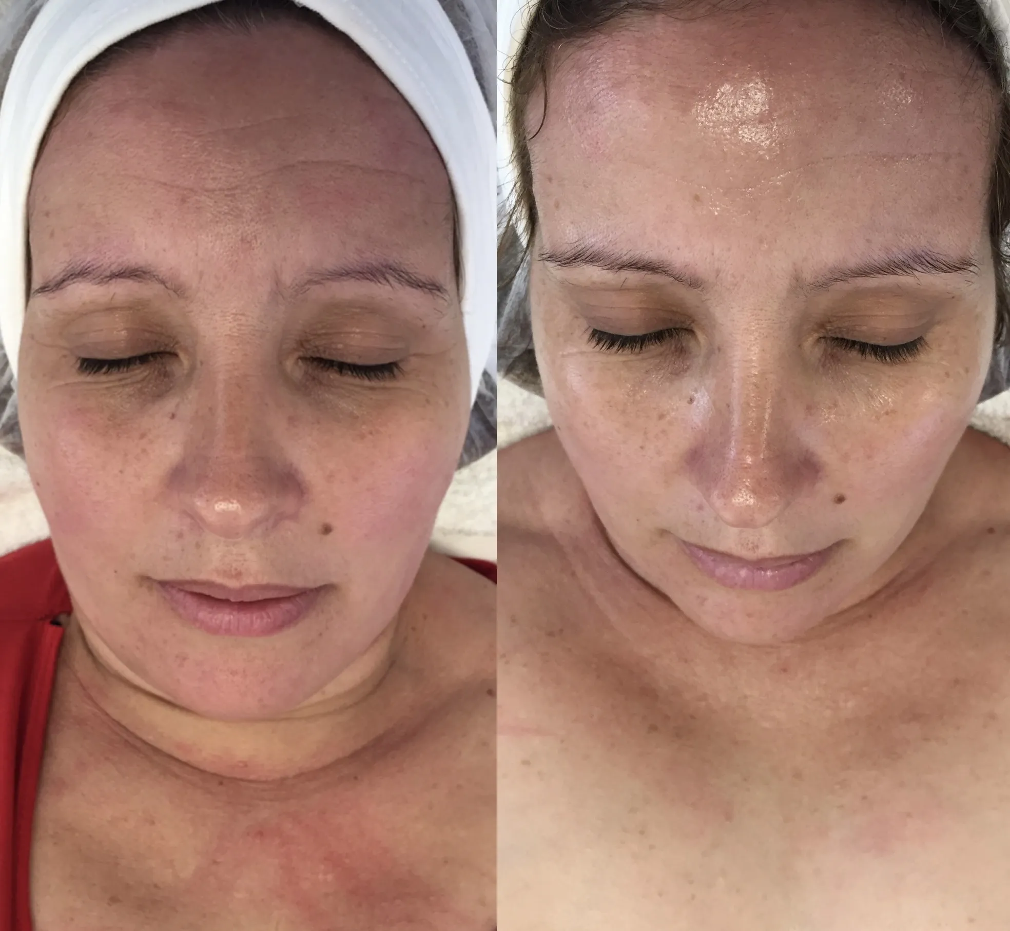 Antienvelhecimento resultado cliente em Cascais - Lourdes Estética