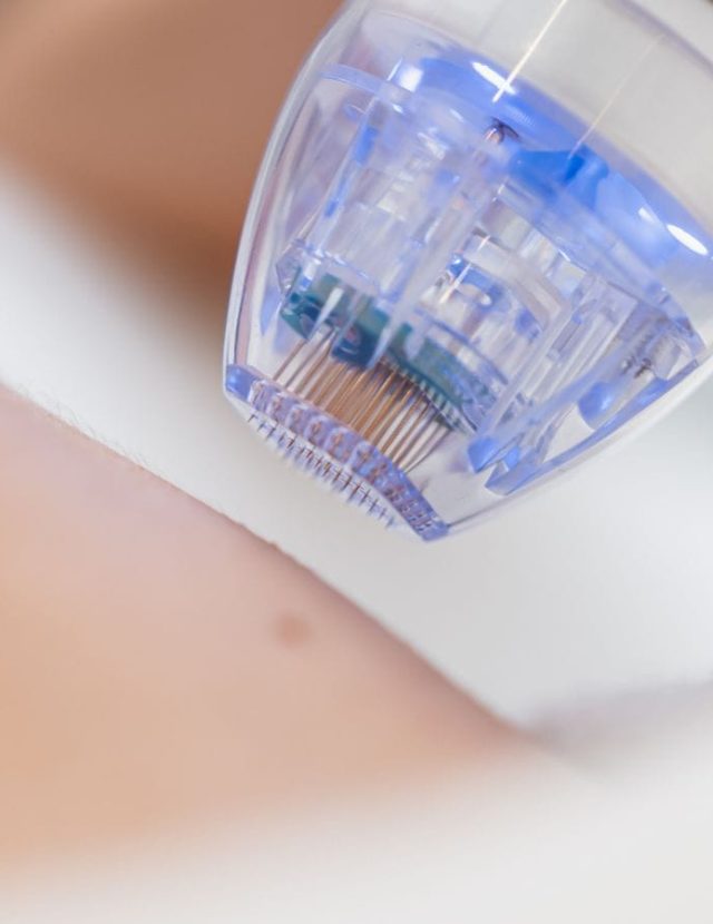 tratamento de radiofrequência fracionada com microagulhas na Lourdes Estetica em Cascais