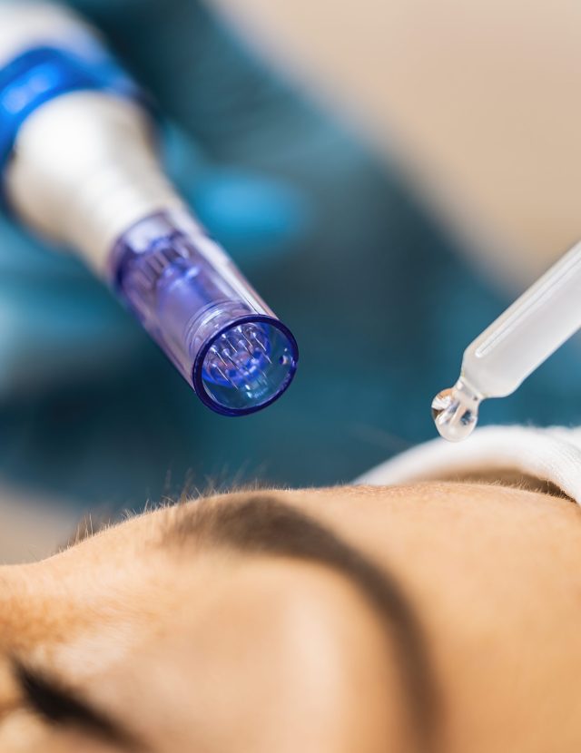 Microneedling