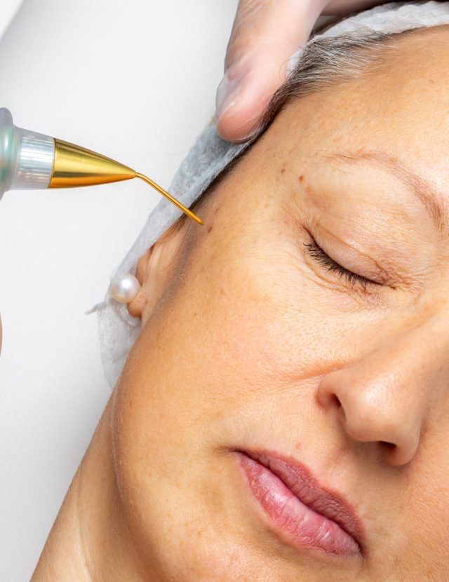 Jato de Plasma em Cascais Na Lourdes Estetica