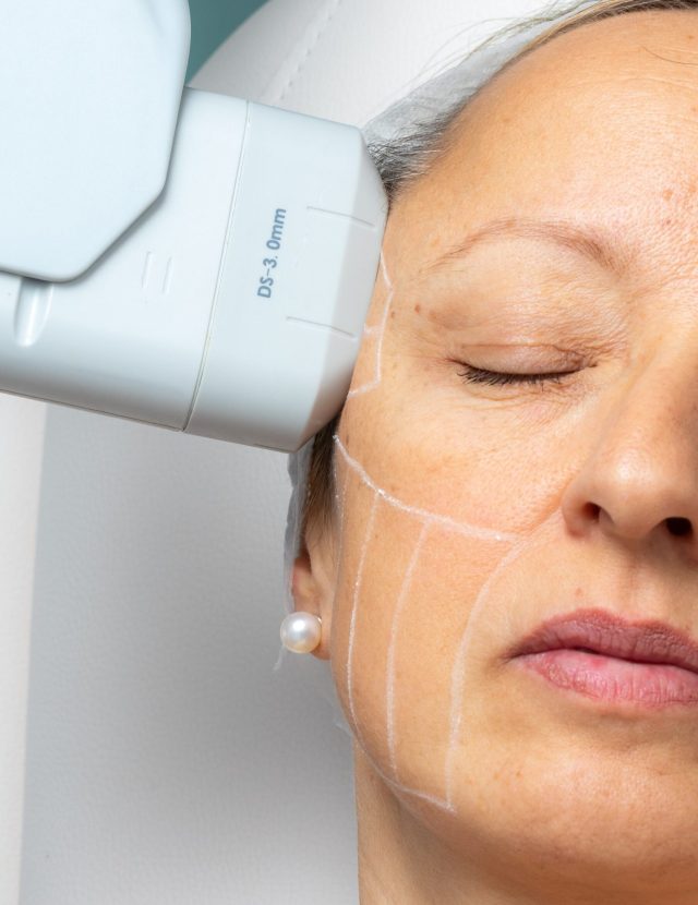 HIFU Facial HIFU Facial em Cascais Lourdes Estetica