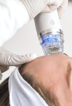 tratamento de radiofrequência fracionada com microagulhas na Lourdes Estetica em Cascais